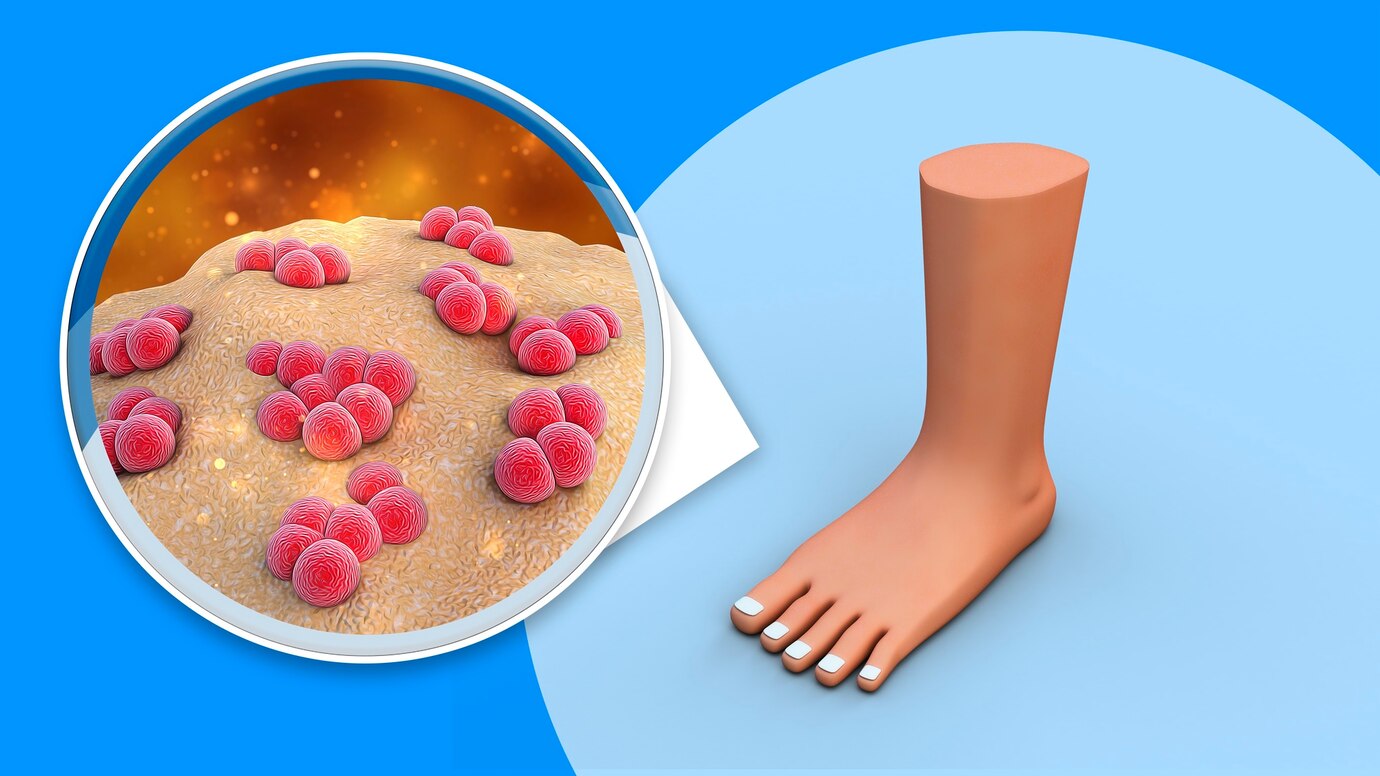 ¿Cómo se llama la bacteria de los pies?