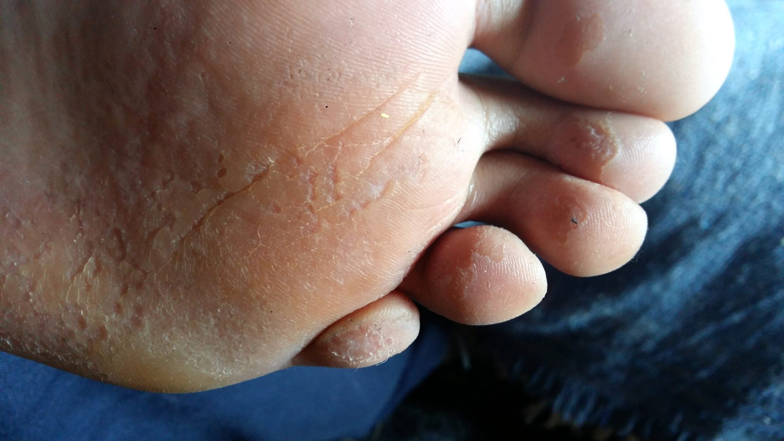 ¿Por qué salen huequitos en los pies?