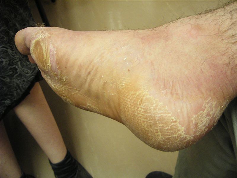 ¿Qué hacer para quitar la piel muerta de los pies?